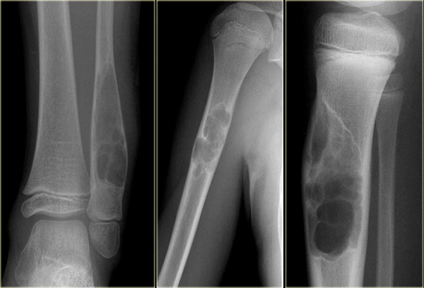 U xương ác tính - Hình ảnh minh họa